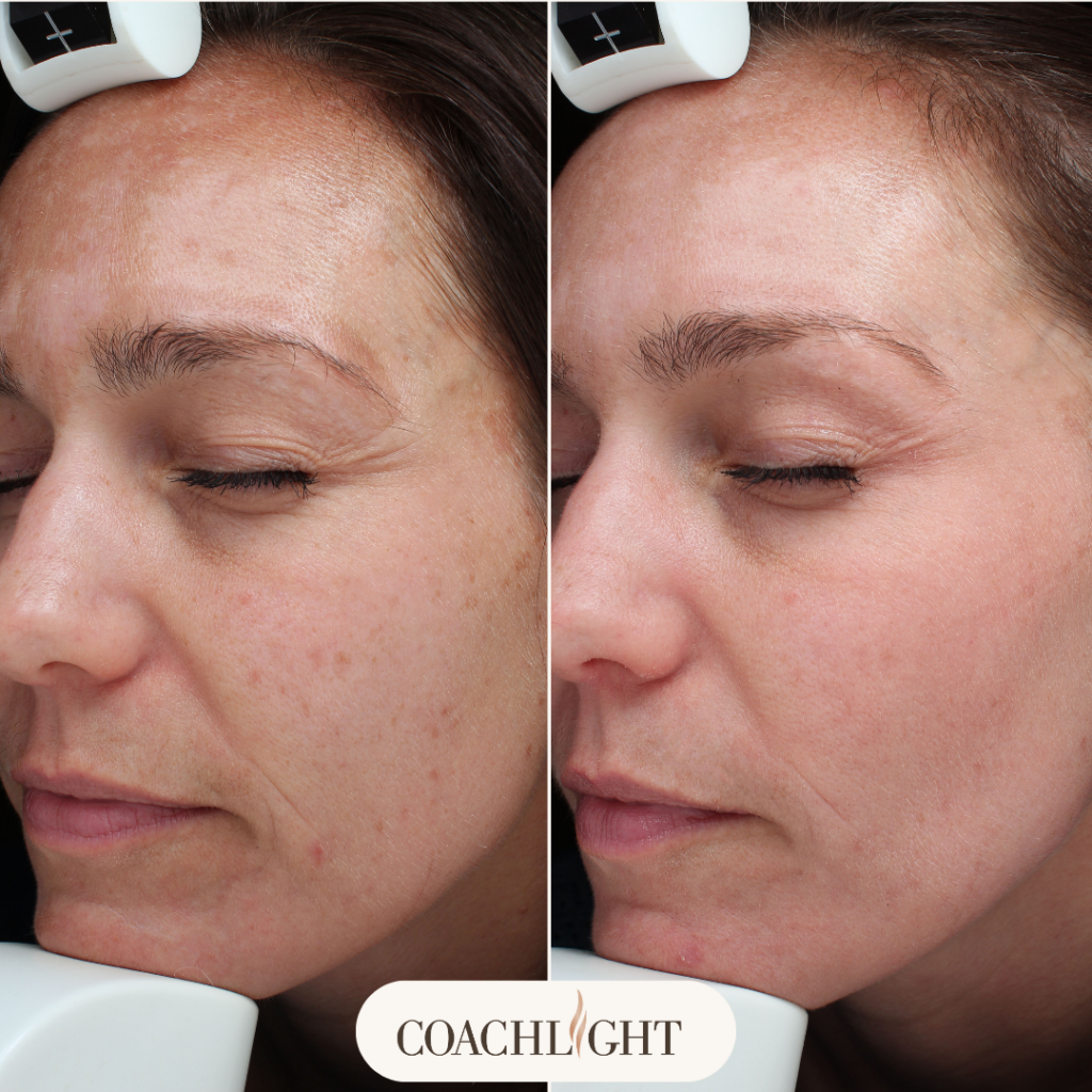 Moxi Laser Treatment 3 Moxi Before And After
