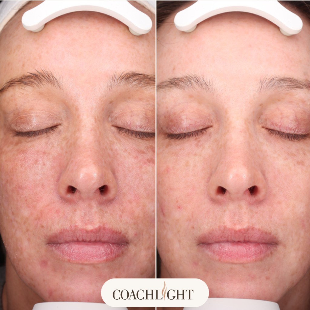 Moxi Laser Treatment 7 Moxi Before And After