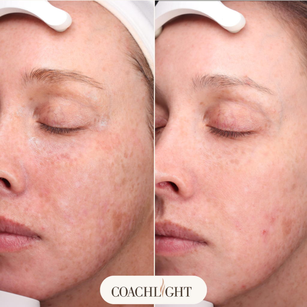 Moxi Laser Treatment 8 Moxi Before And After