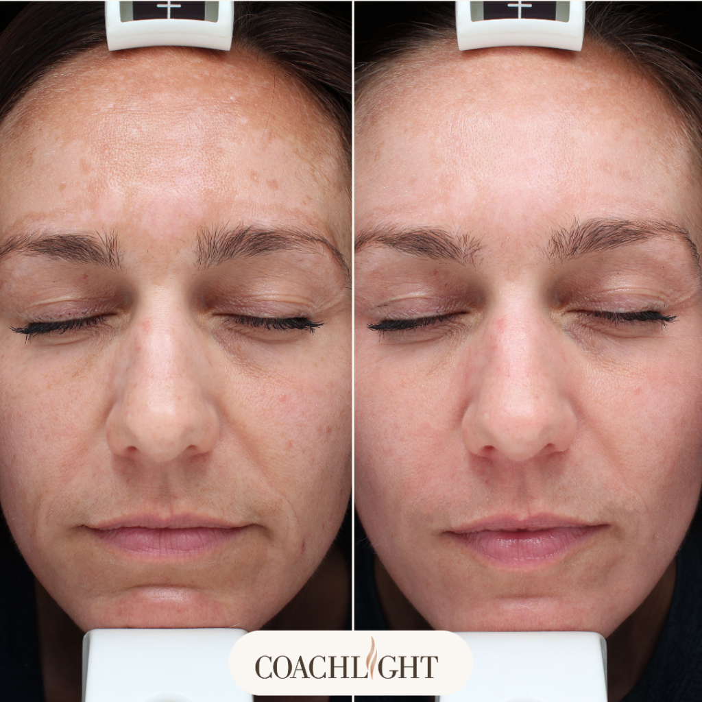 Moxi Laser Treatment 2 Moxi Before And After