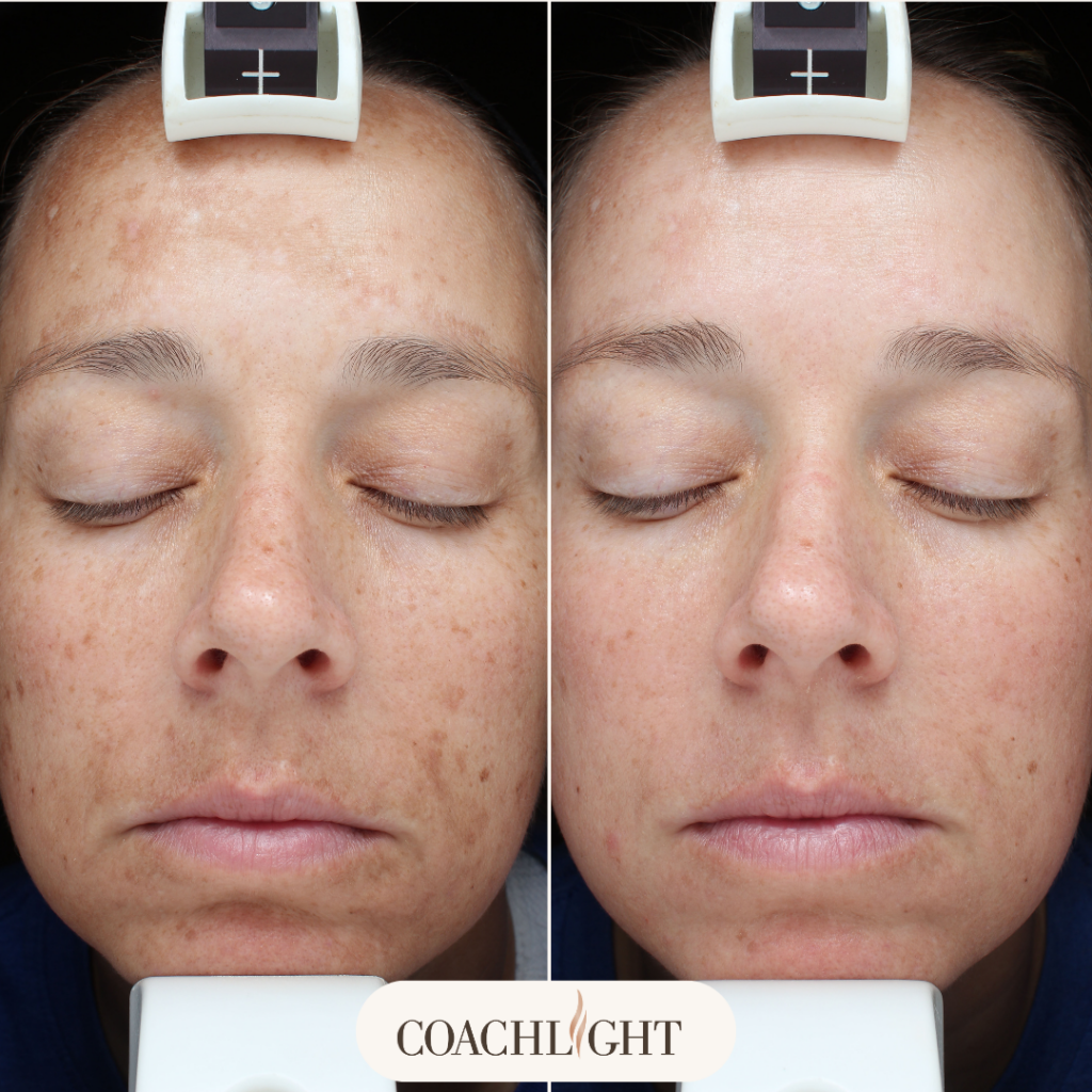 Moxi Laser Treatment 5 Moxi Before And After