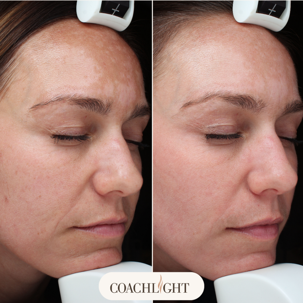 Moxi Laser Treatment 1 Moxi Before And After