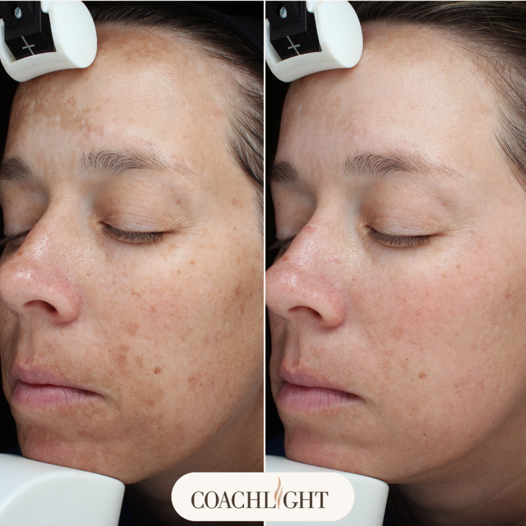 Moxi Laser Treatment 4 Moxi Before And After