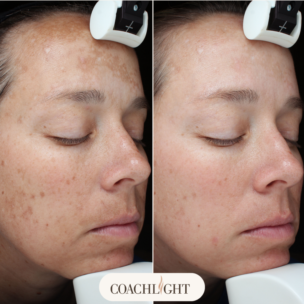 Moxi Laser Treatment 6 Moxi Before And After