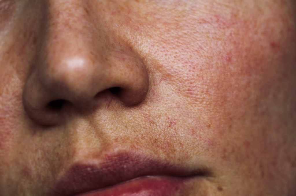 Moxi Laser Treatment 10 Sun Damage