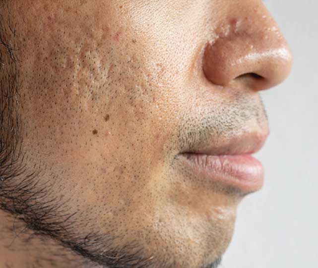 Microneedling Acne Scar Treatment For Men In Des Moines Acne Scar Reduction On Male Skin With Microneedling At Coachlight