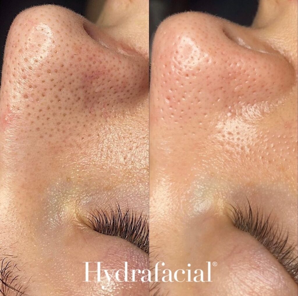 Hydrafacial 4 Hydrafacial Pores Before And After