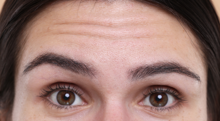 When Do Wrinkles Start To Appear? 2 Treating Wrinkles