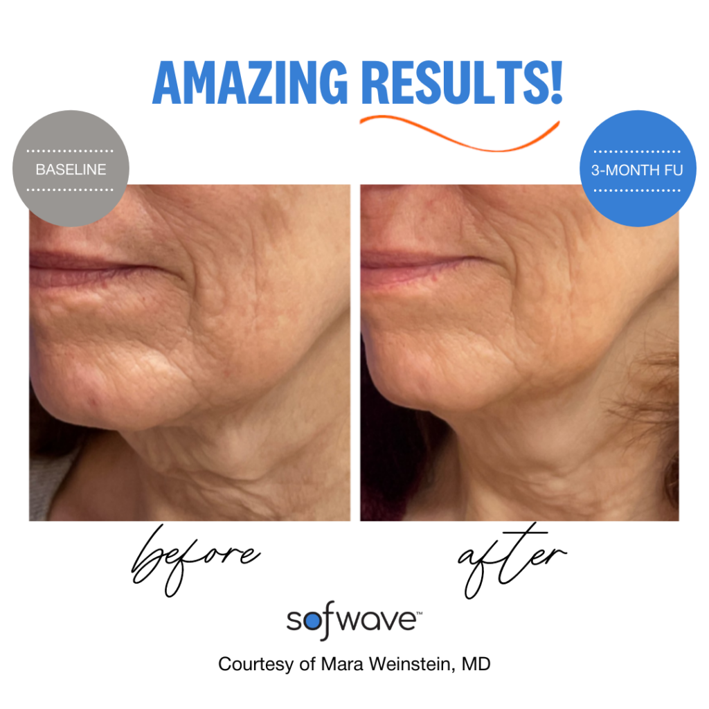 Sofwave™ 5 Sofwave Before And After Jawline Skin Tightening Results
