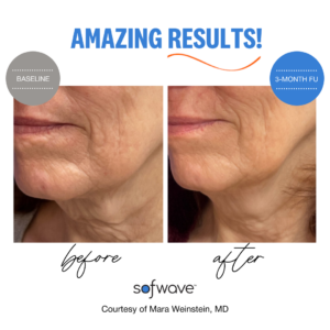 Sofwave before and after jawline skin tightening results
