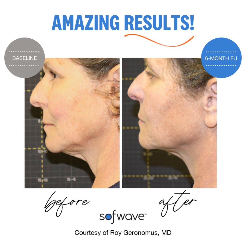 Sofwave™ 4 Before And After Graphic