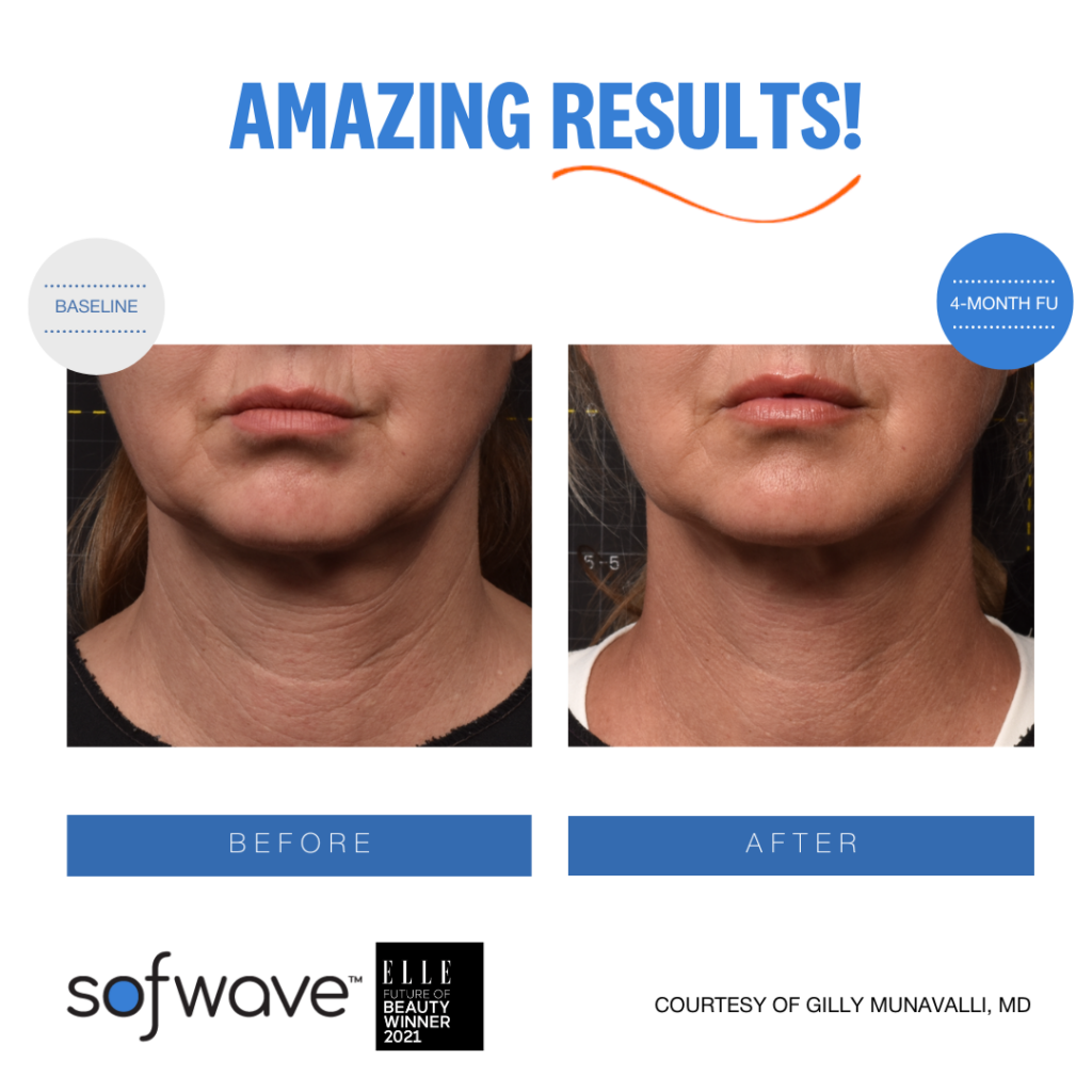 Sofwave™ 8 Ser Neck