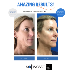 Set Full Face