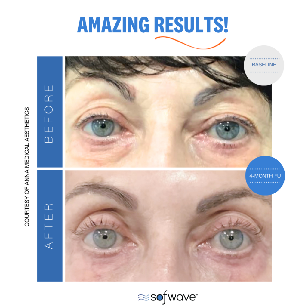 Sofwave™ 11 Set Eyebrow