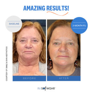 Set Full Face