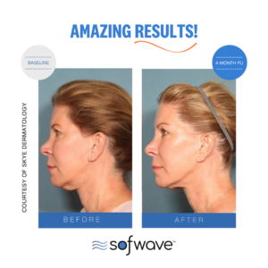 Sofwave before and after photos