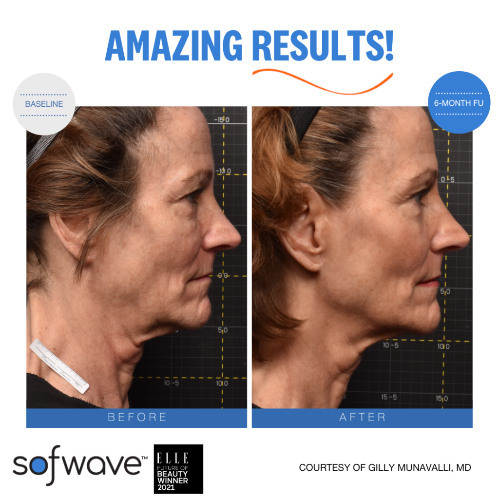 Sofwave™ 9 Set