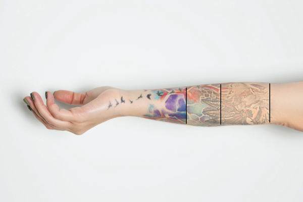 Laser Tattoo Removal