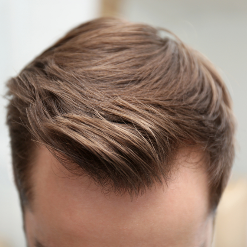 Hair Thinning &Amp; Loss Treatments 4 Neograft