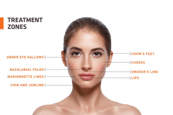 Prf Ezgel 4 Prf Ez Gel Treatment Zones