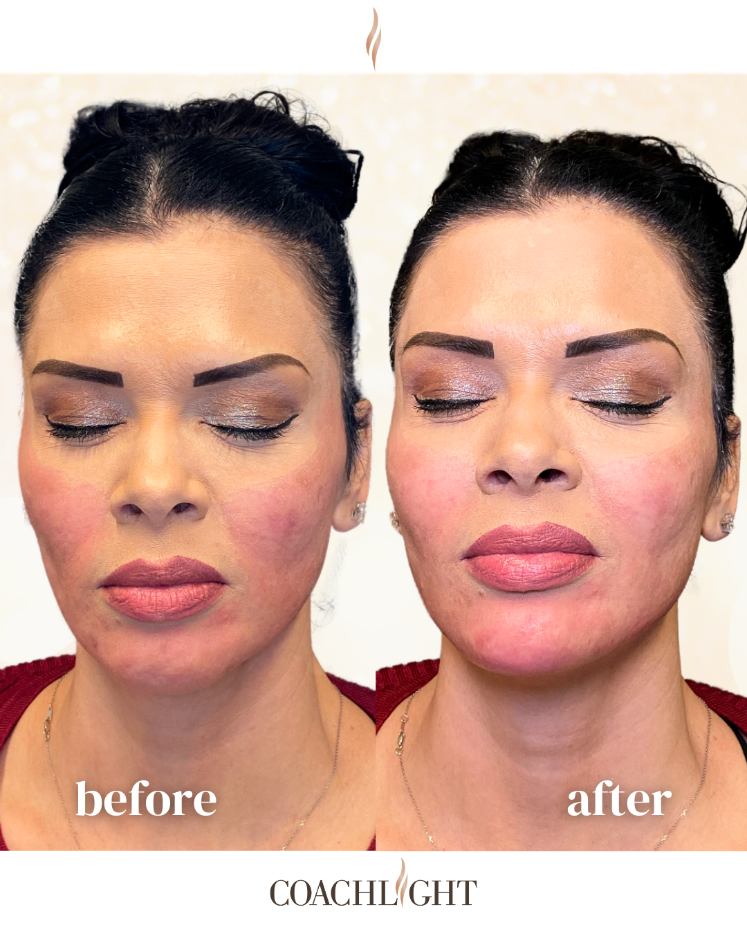 Facial Filler Rejuvenation Package 6 Facial Balancing