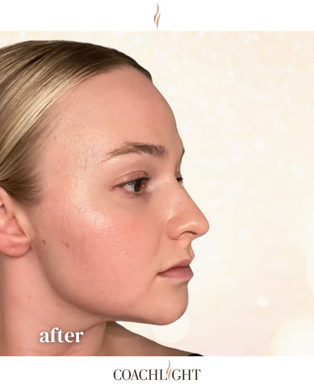 Facial Filler Rejuvenation Package 5 Jawline ()