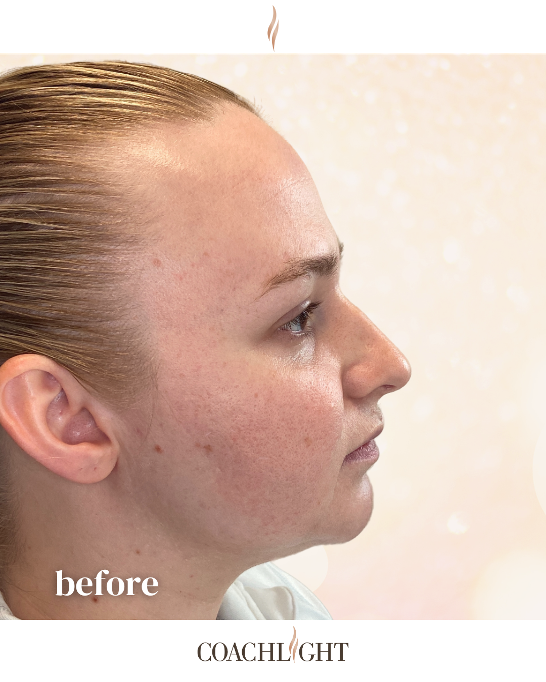 Facial Filler Rejuvenation Package 4 Jawline