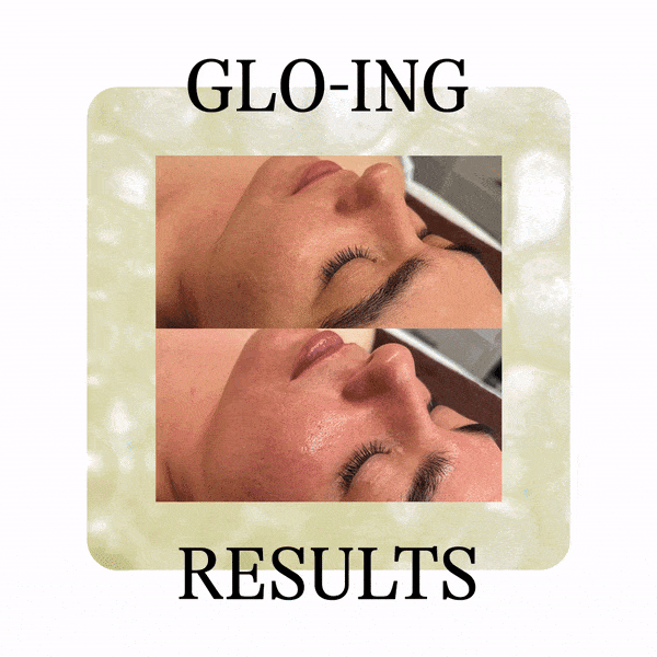 Glo2Facial 4 Before &Amp; After Gif