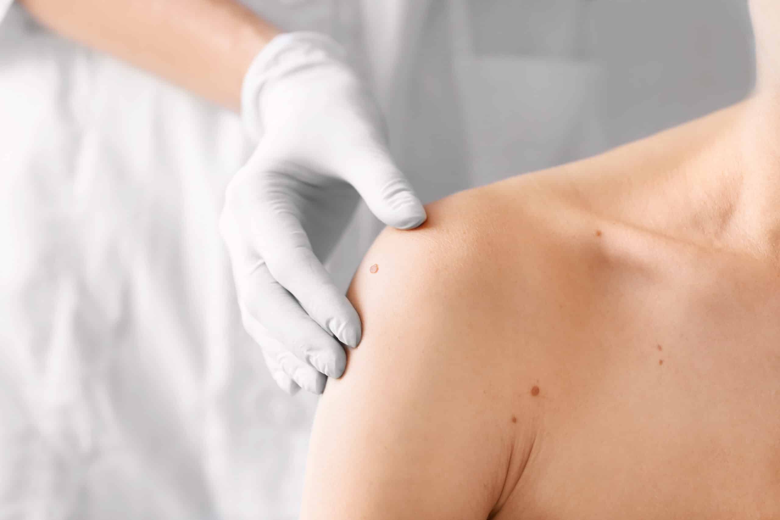 Why Dermatologists Love Bbl Moxi Halo Lasers