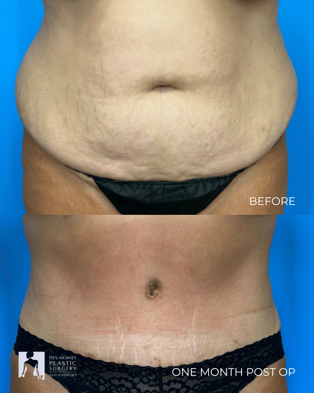 Abdominoplasty ()