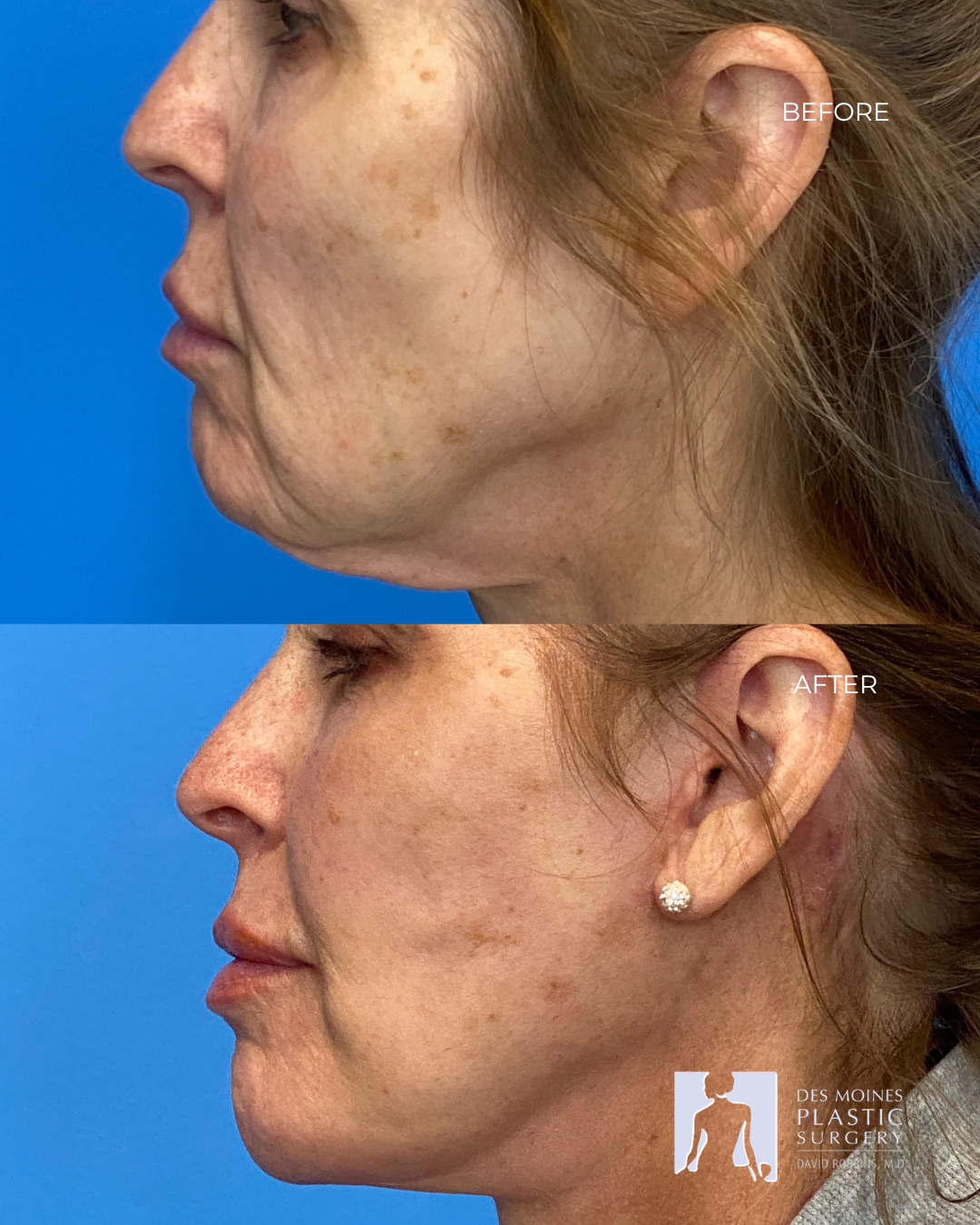 Specials &Amp; Events 6 S Lift Before And After