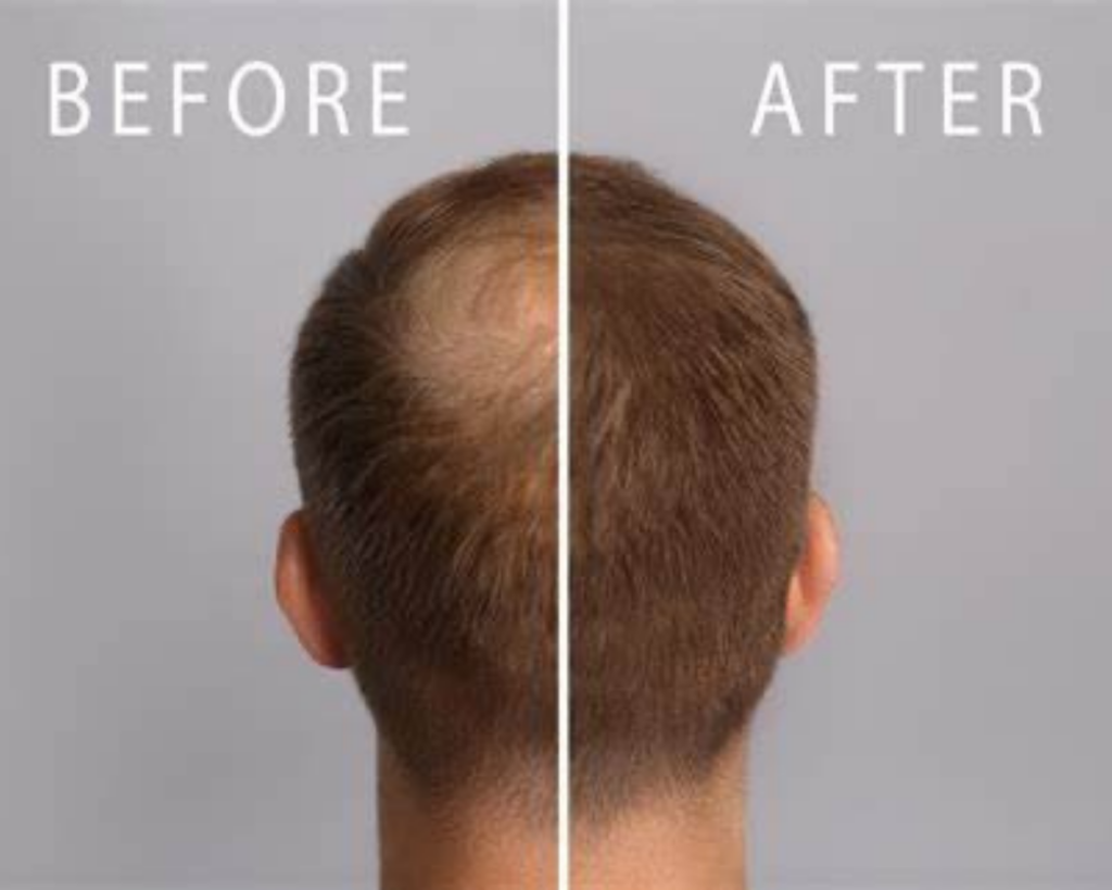 Gerhairmd Before And After