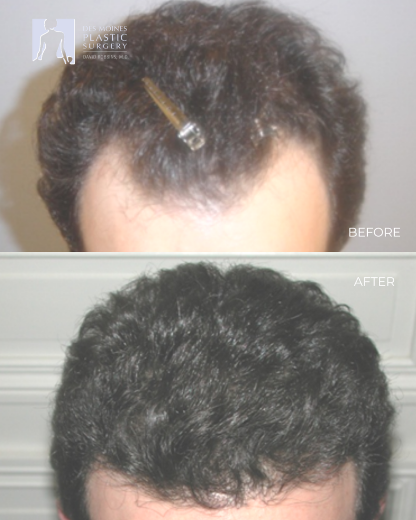 Neograft Before And After ()